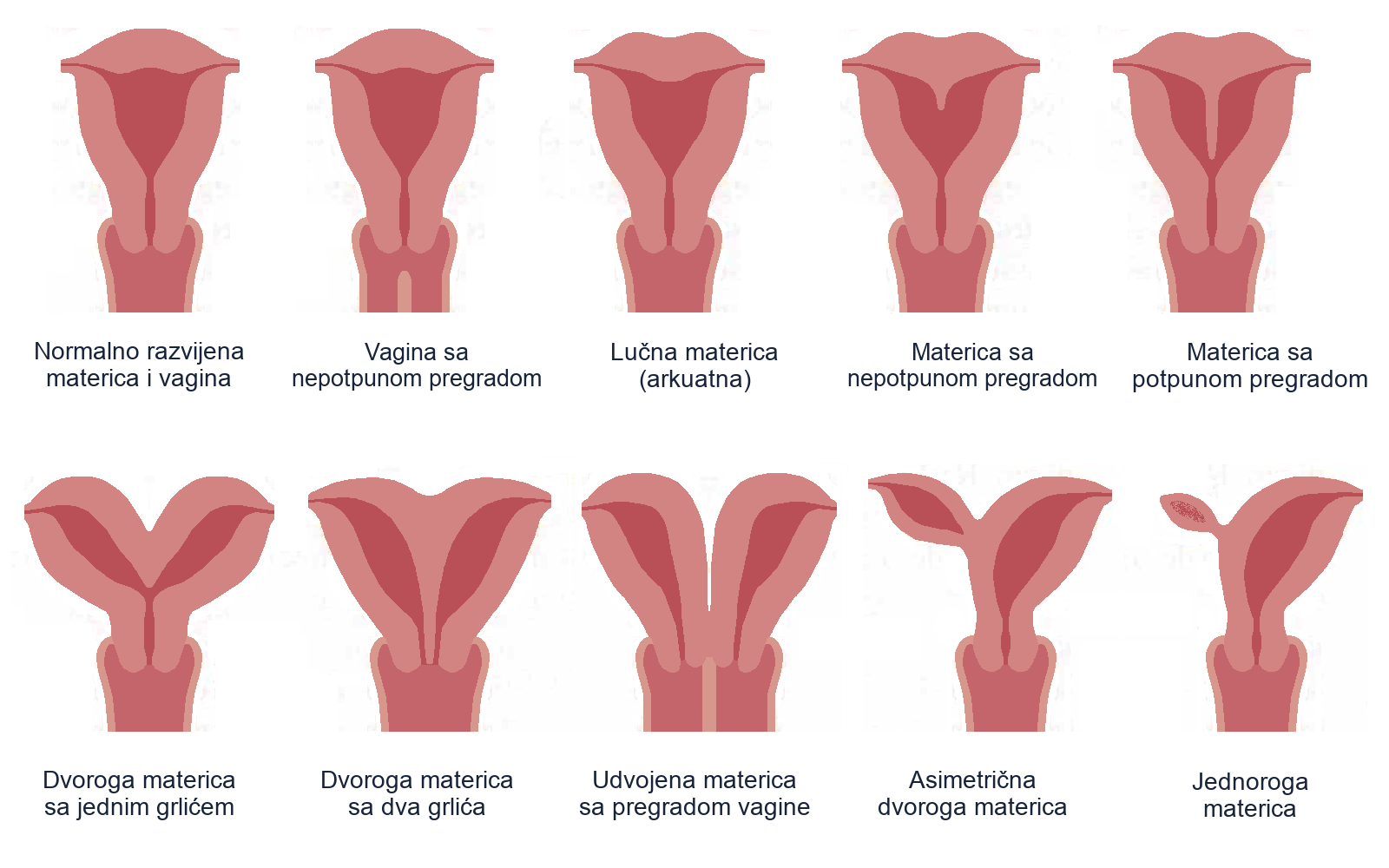 Uporedni medicinski crteži normalnog oblika i urođenih anomalija materice.