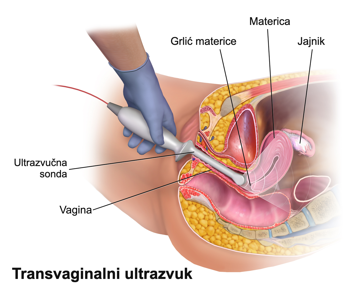 Transvaginalni ginekološki ultrazvuk