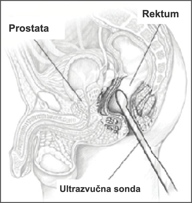 Šema transrektalnog ultrazvuka