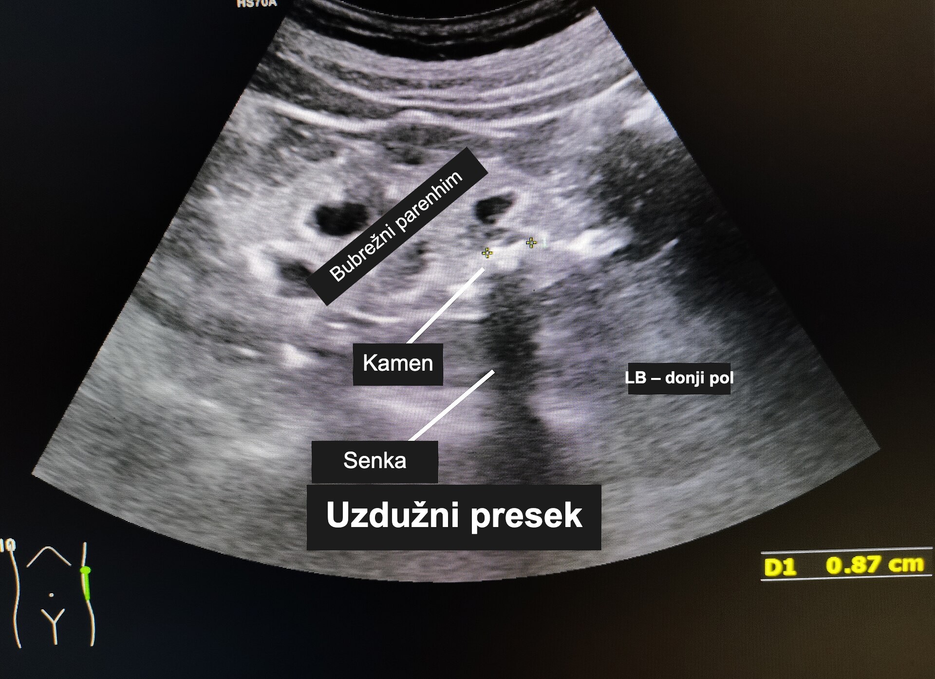 Ultrazvučni snimak bubrega