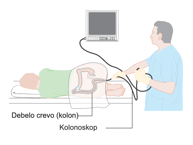 Šema pacijenta koji leži na boku dok lekar uvodi kolonoskop u debelo crevo, uz ekran.