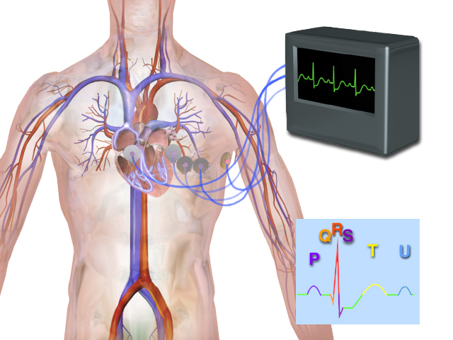 Telo sa srcem i elektrodama povezanim sa EKG aparatom; uvećan prikaz talasa P, QRS, T i U.