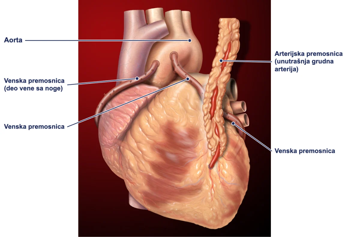 Aortokoronarni bajpas – venske i arterijska premosnica