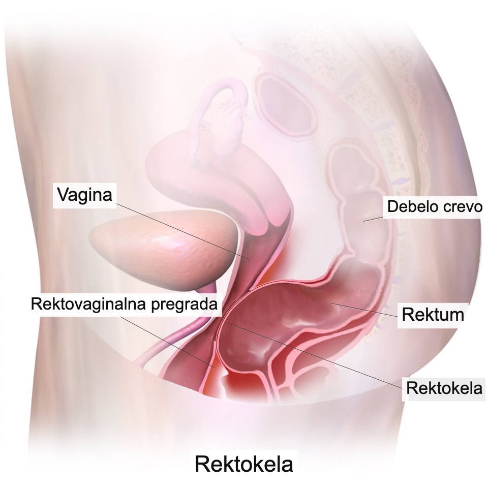 Bočni presek karlice žene sa rektokelom: završni deo creva izbočava zadnji zid vagine.