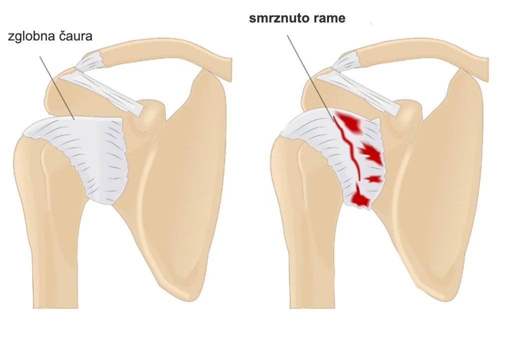 Crtež zdrave zglobne čaure ramena i zadebljane, upaljene čaure kod smrznutog ramena.