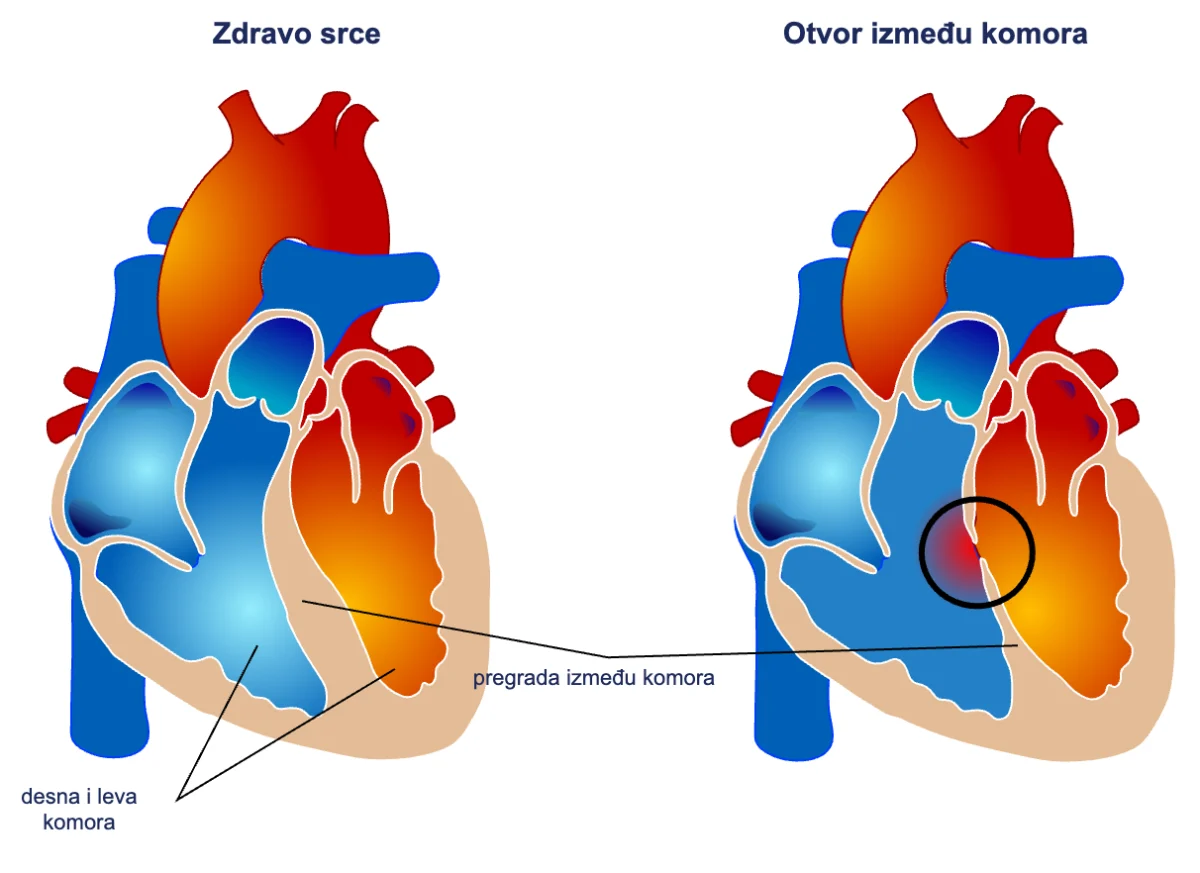 Otvor između srčanih komora – urođena srčana mana
