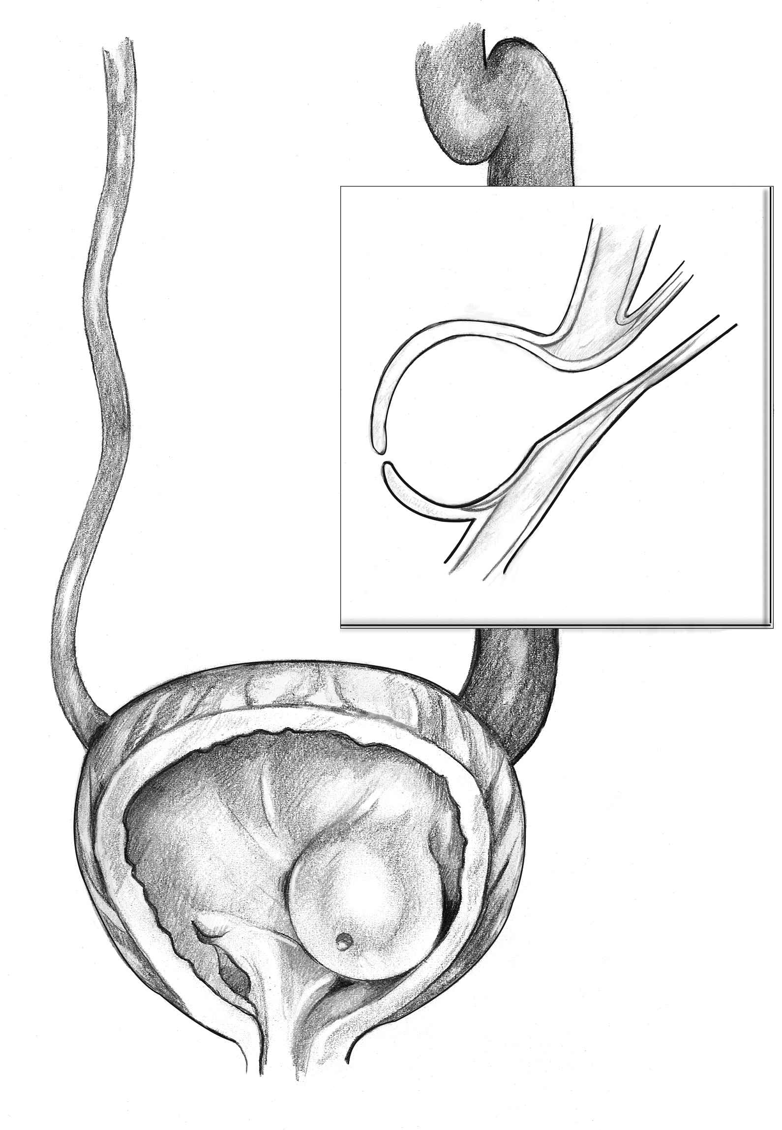 Medicinska ilustracija ureterocele u bešici, sa uvećanim detaljem.